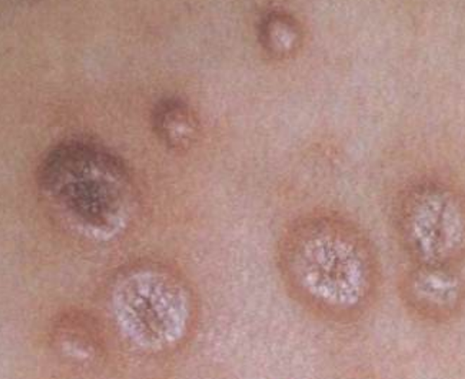 梅毒生殖系统症状图片图片