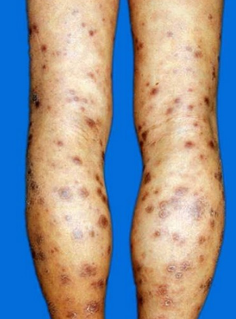 男性二期梅毒症状图片图片