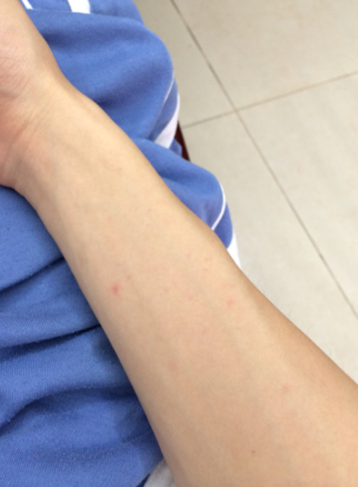 二期梅毒疹初期图片