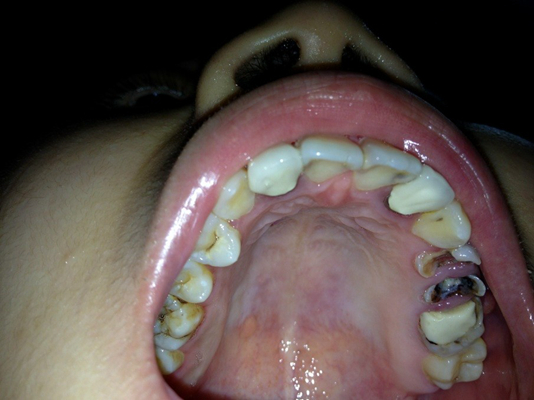 牙釉质发育不全 (15)