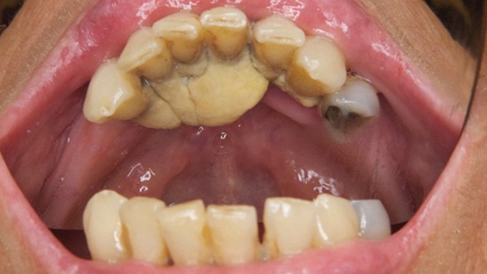 牙釉质发育不全 (48)