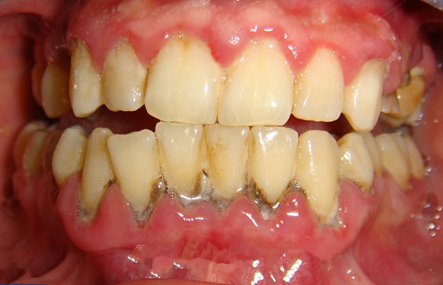 牙釉质发育不全 (42)