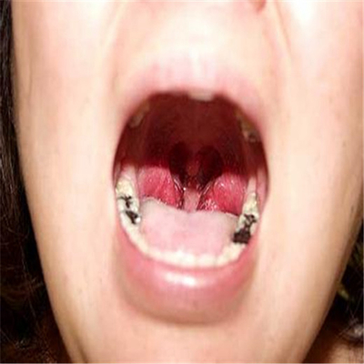 牙釉质发育不全 (4)