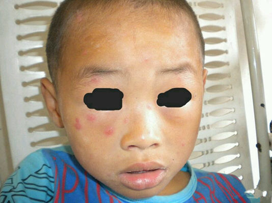 小孩水痘症状图片 (60)