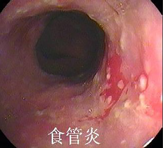 食管炎