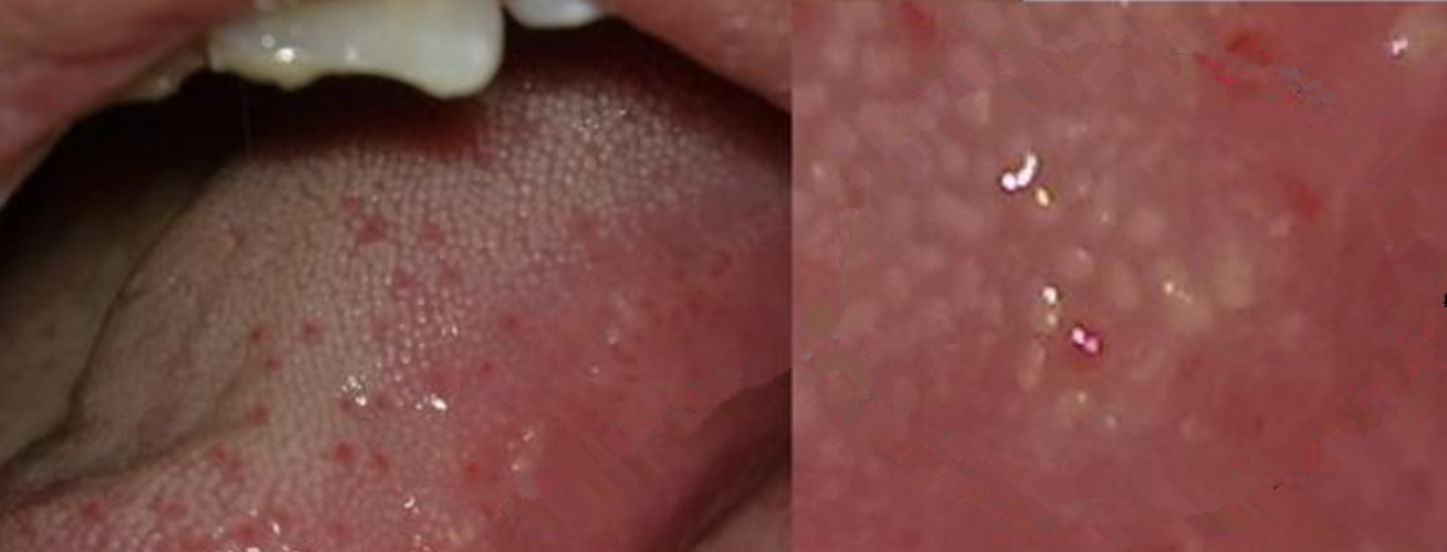 舌头hpv感染的症状图片