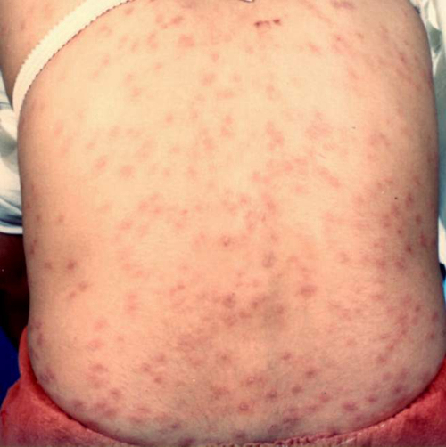 梅毒斑丘疹图片症状图片