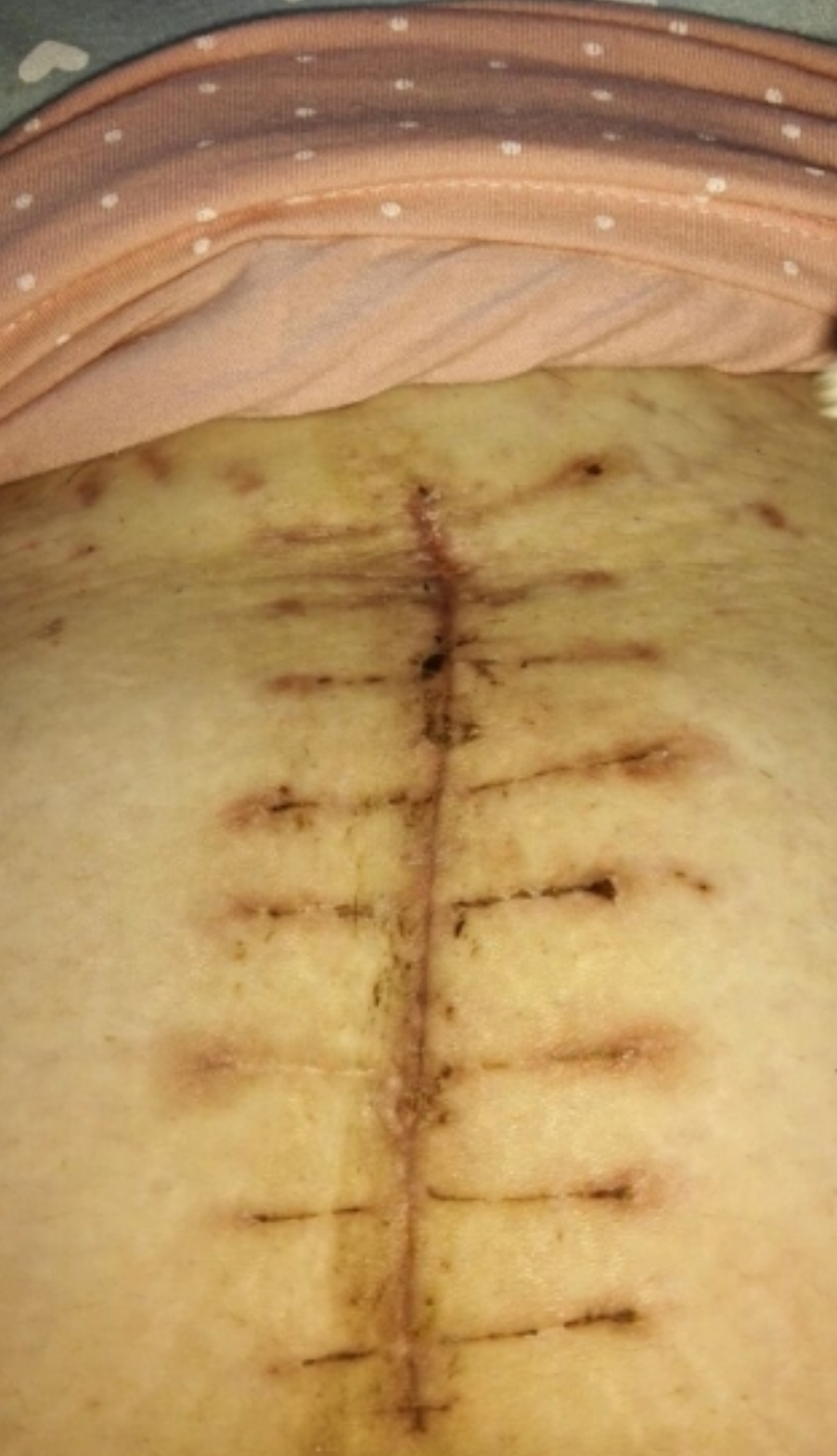 剖腹产疤痕恢复过程图图片