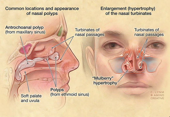 空鼻症患者图片 (3)