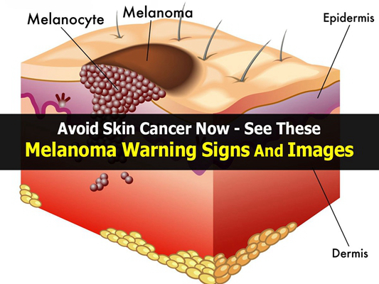 皮肤癌的早期特征图片 (3)