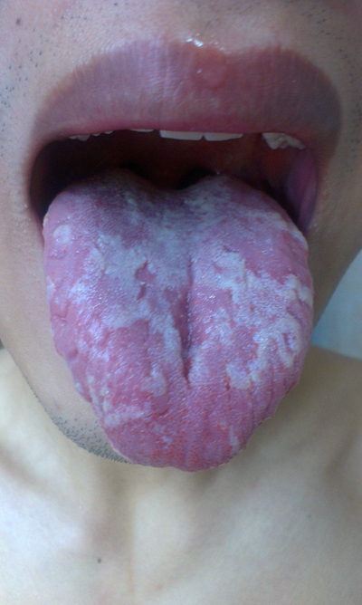 舌苔有裂纹 (39)