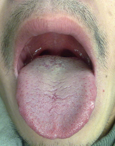 舌苔有裂纹 (44)