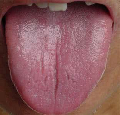 舌苔有裂纹 (11)