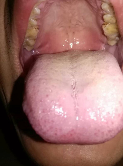 舌苔有裂纹 (22)