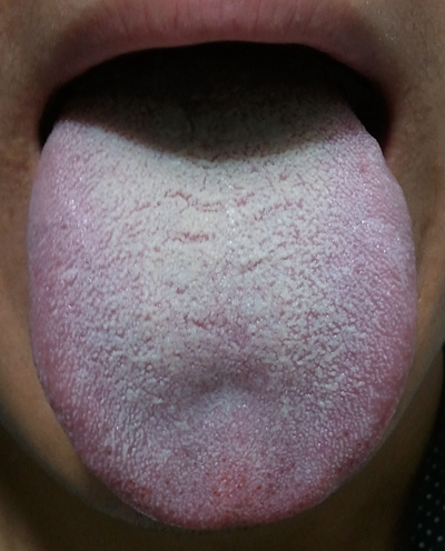 舌苔有裂纹 (28)