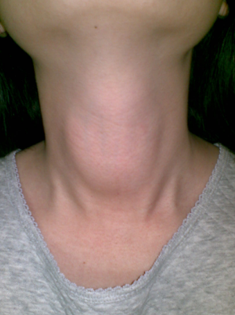 甲亢脖子症状图片 (22)