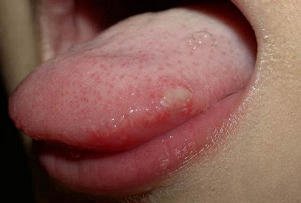 浸润性舌癌照片图片