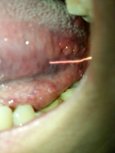 女生舌癌 初期图片