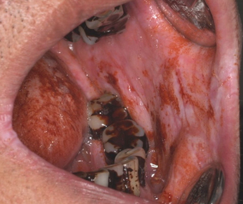 舌癌的初早期症状图片 (2)
