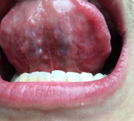 口腔癌舌头图片