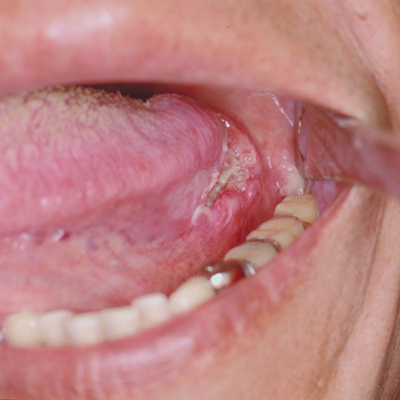 舌癌的初早期症状图片 (11)