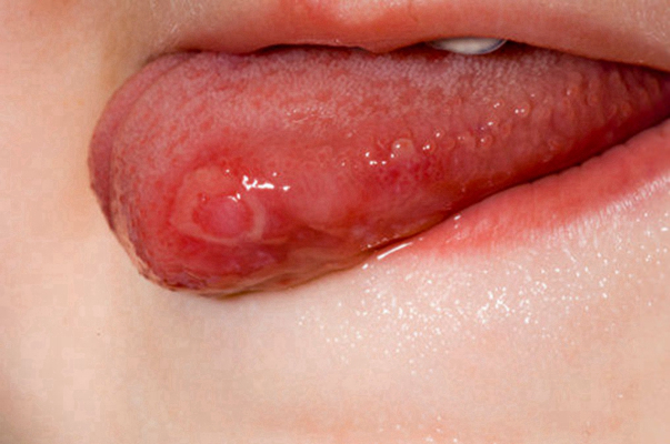 感染hpv的舌头图片