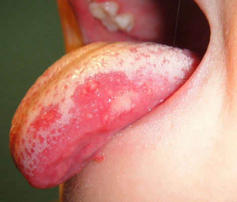 舌癌的初早期症状图片 (44)