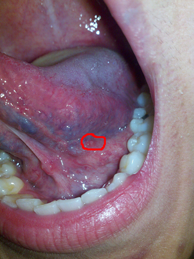 舌癌的初早期症状图片 (6)