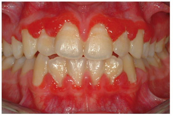 牙龈炎和牙周炎图片 (82)
