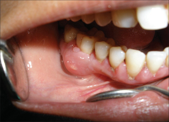 牙龈炎和牙周炎图片 (74)