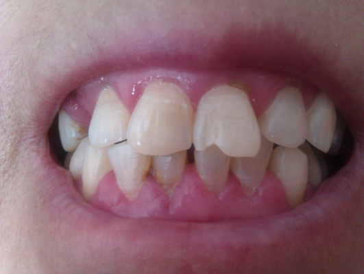 牙龈炎和牙周炎图片 (8)