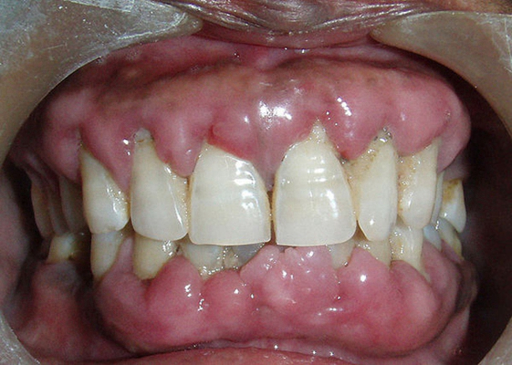 种植牙后牙龈发炎图片图片