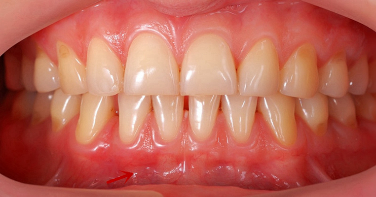 牙龈炎和牙周炎图片 (44)