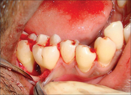 牙龈炎和牙周炎图片 (58)