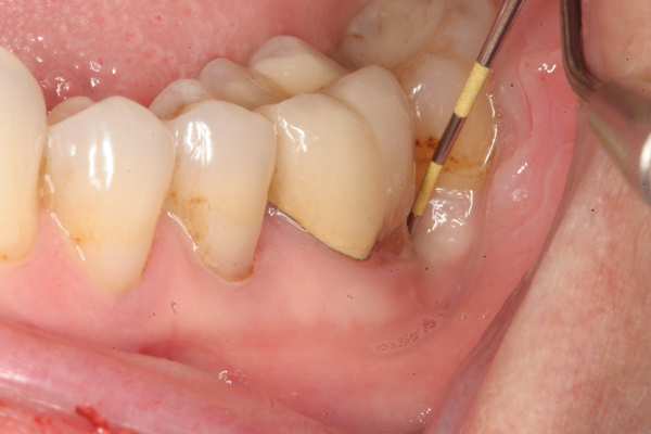 牙龈炎和牙周炎图片 (52)