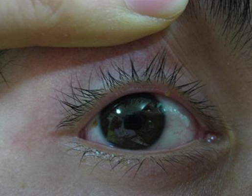 轻微沙眼的症状图片 (3)