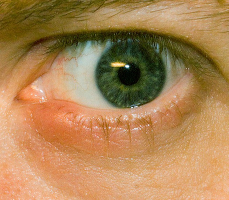 轻微沙眼的症状图片 (43)