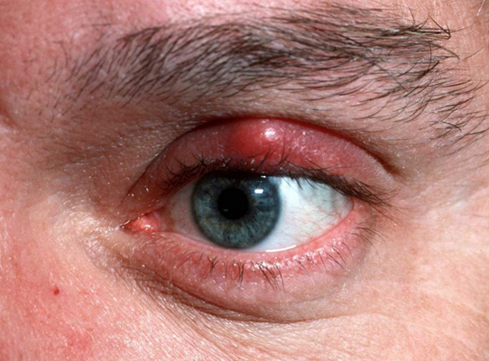 轻微沙眼的症状图片 (49)