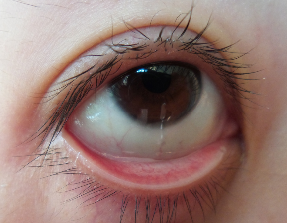 眼角膜发炎图片 (65)