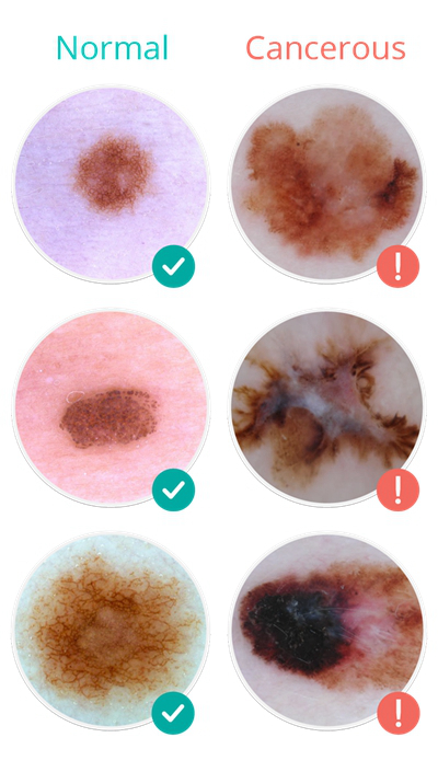 皮肤癌的早期特征图片 (12)
