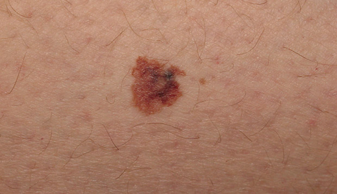 皮肤癌的早期特征图片 (1)