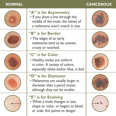 皮肤癌的早期特征图片 (23)