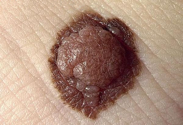 皮肤癌的早期特征图片 (20)