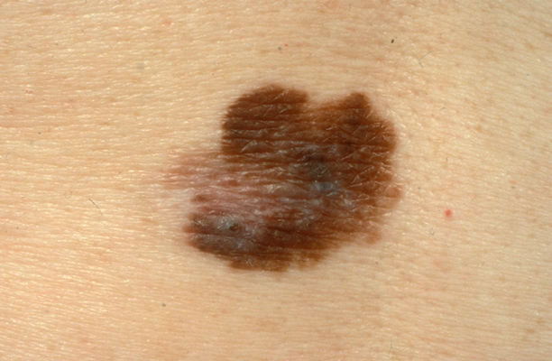 皮肤癌的早期特征图片 (26)