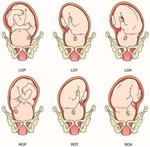 胎儿rot胎位示意图图片