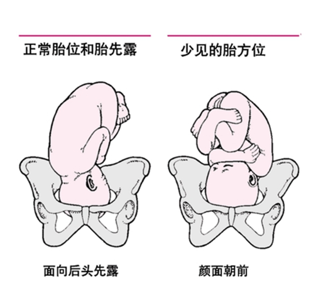 胎方位LSA图片