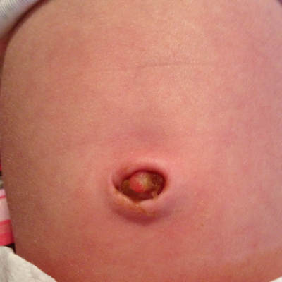 女宝宝肚脐疝气图片图片