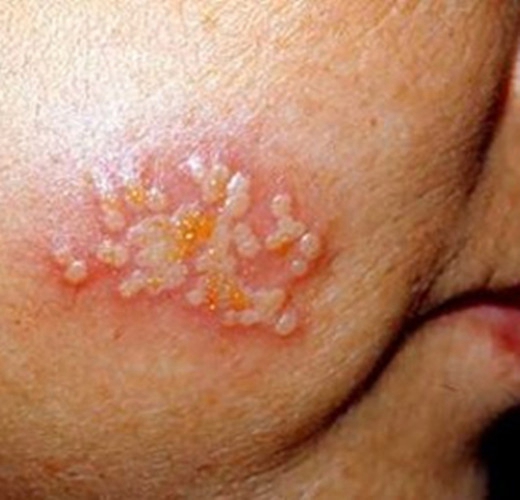 尖锐性湿疹疣症状图片