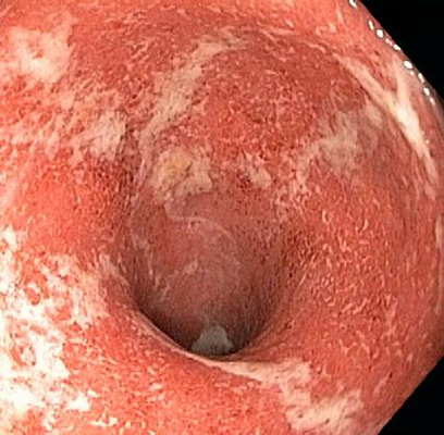 肛管癌早期图片图片