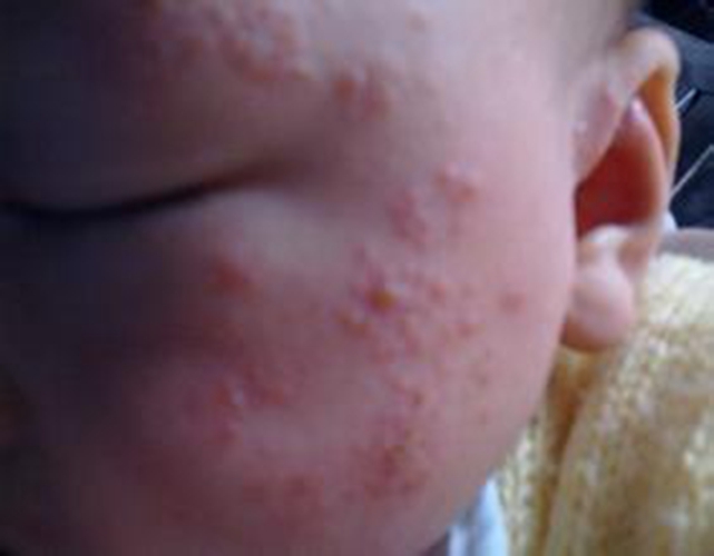 小儿急疹和水痘的图片